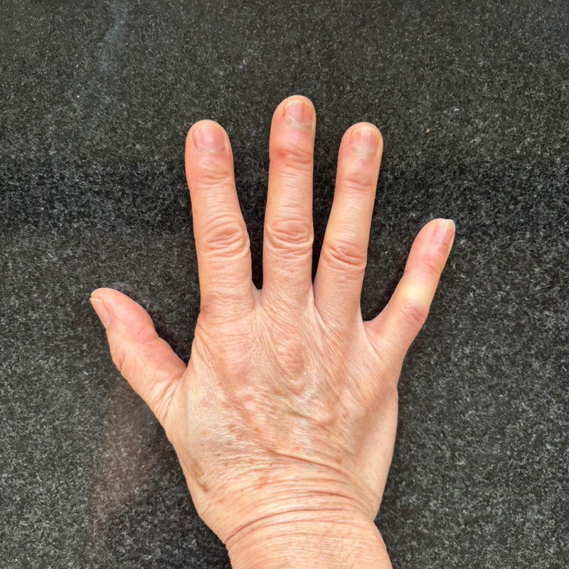 #239 CM母指関節症が良くなってきた&昔の放送聞いてくれてありがとう