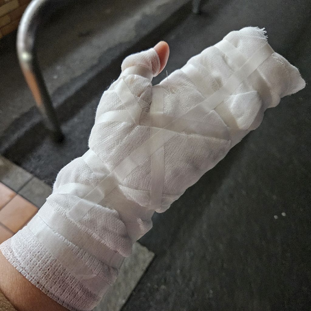 第375回 やけどその後