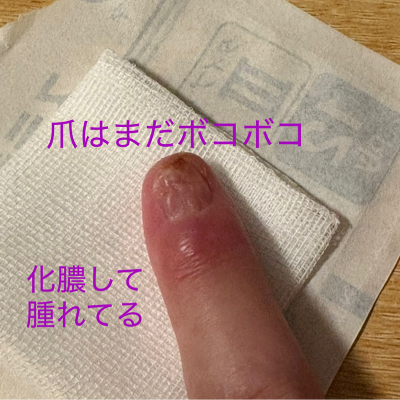 グロムス腫瘍という奇病_#104