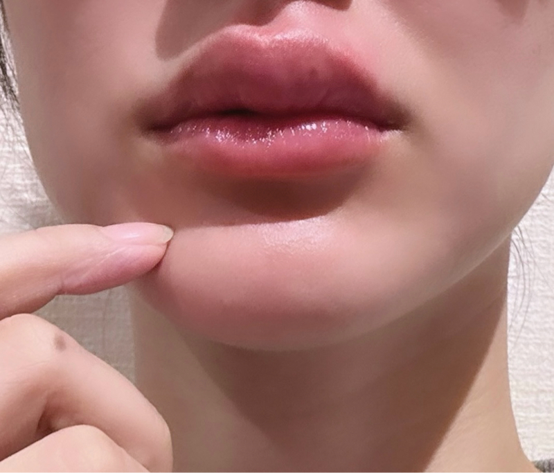 アレルギーで意図せずセクシーレディ