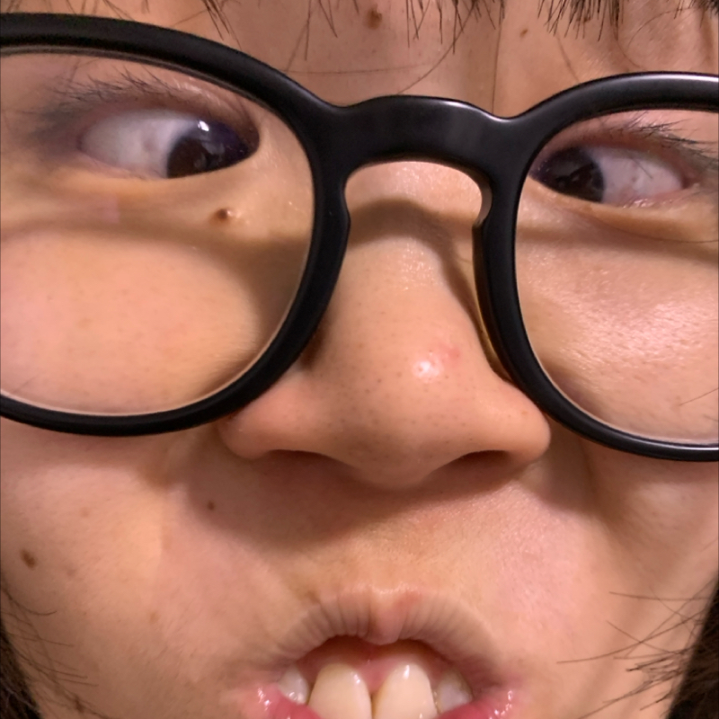 #1181 ふくらはぎにキズ